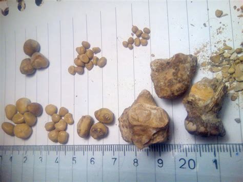 How Big is 6 mm Kidney Stone: A Grain of Sand or a Mountain in Your Body?