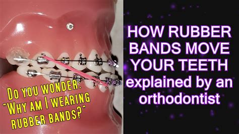 How Long Does It Take for Rubber Bands to Move Teeth: A Journey Through Time and Elasticity