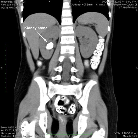 What Does a Kidney Stone Look Like on a CT Scan: A Journey Through the Labyrinth of Medical Imaging and Beyond